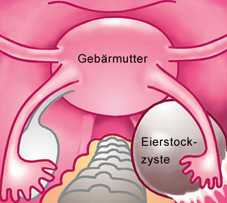 Lassen entfernen zyste eierstock Ist eine